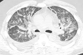 Definitions of acute lung injury (ali) and acute respiratory distress syndrome (ards) have varied over time. Pulmcrit Ards Vs Pseudoards Failure Of The Berlin Definition