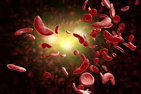 What is sickle cell disease? Challenges Of Developing And Facilitating Access To New Sickle Cell Disease Therapies Case Of The Deferoxamine Patch