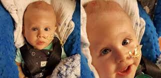 Veja o resultado da cirurgia do bebê que nasceu com o cérebro fora do  crânio