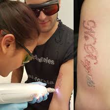 Looking for the best tattoo removal in rush green, london and overwhelmed by the options? Laser Tattoo Removal In North London Blue Light Dental Clinic