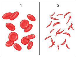 Bei homozygot erkrankten sind alle erythrozyten betroffen. Biofunk 22 Sichelzellanamie Wie Eine Genmutation Eine Krankheit Verursacht Biofunk Der Biologie Podcast