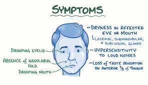 Signs and symptoms of bell's palsy come on suddenly and may include: Bell S Palsy A Half Smile Paralysis