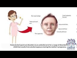 Epicanthus is a vertical fold of skin over the angle of the inner canthus of the eye. Fetal Alcohol Syndrome Causes Signs And Symptoms Diagnosis And Treatment Youtube