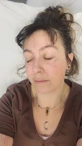 Cosmetic acupuncture break!, I will be giving myself a full series of  cosmetic acupuncture that I would suggest to any client my age to show the  honest results of a full and regular treatment, I am 35 ...