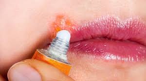 You cannot get rid of cold sores overnight. 10 Cold Sore Faqs Answered Everyday Health