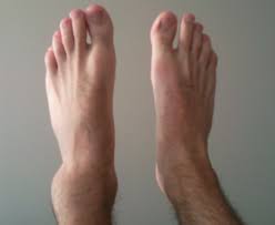 How To Heal A Sprained Ankle Overnight At Home With Effective Results Sprained Ankle Treating A Sprained Ankle Sprain