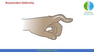 Image result for Elson Extensor Tendon Test