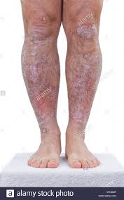 Psoriasis Ist Eine Chronische Entzundliche Erkrankung Der Haut Details Der Beine Stockfotografie Alamy