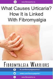 What Causes Urticaria How It Is Linked With Fibromyalgia Fibromyalgia Fibro Urticaria Chronic Fatigue Symptoms Chronic Fatigue Syndrome Symptoms