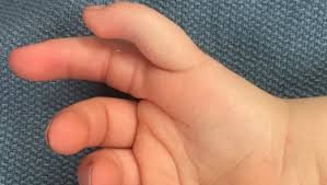 We did not find results for: Children With Congenital Hand Anomalies Malformations Healthychildren Org