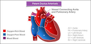 Learn about pda heart with free interactive flashcards. Patent Ductus Arteriosus Boston Children S Hospital