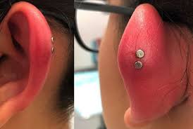 How do ear piercings even get infected? Swollen Cartilage Piercings Causes Treatment Authoritytattoo