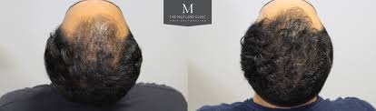 Because it works by lowering dihydrotestosterone (dht) levels, it's assumed it can reduce hair loss for a majority of. How Long Does Prp Hair Treatment Last Hair Loss Results