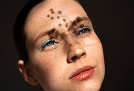 Image result for Solar Lentigo