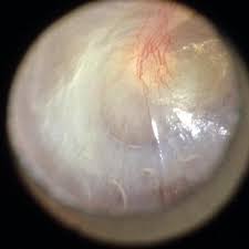 Image result for Myringosclerosis