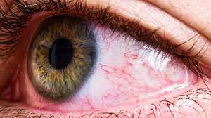 Puffy And Swollen Eyelid Treatment Home Remedies Everyday Health