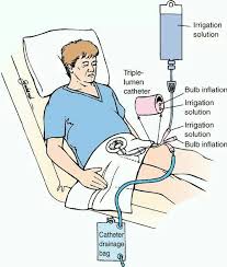Irrigation Nursing Information Prostate Surgery Catheter