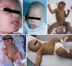 An inherited disease that is present at birth and is characterized especially by abdominal wall defects (such as umbilical hernia), increased birth. Beckwith Wiedemann Syndrome Springerlink