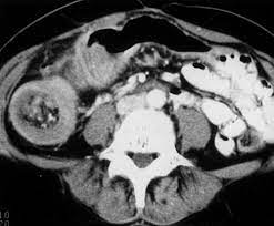 Ct scans are most often an outpatient procedure. Spiral Ct Of Colon Cancer Imaging Features And Role In Management Radiographics