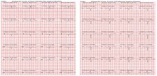 The culprit vessel in this case was an occluded first diagonal branch of the lad. Patient With Nstemi And Cabg