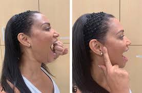 Postrehabilitation Considerations for Individuals With Temporomandibular  Disorders