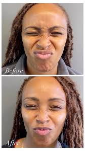 Before and after of our patient’s first ever Botox treatment! , Our  Physician Assistant, Michael Bontekoe, treated her glabella and bunny lines  to give a natural, yet softened look. , To book your ...