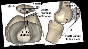 Image result for Patella Tracking Assessment