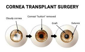 Image result for Cornea