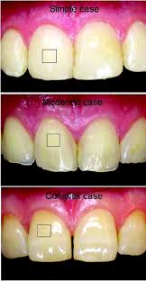 Evaluating Tooth Color Matching Ability Of Dental Students