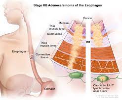 There are two types of esophageal cancer: Esophageal Cancer Treatment Adult Pdq Patient Version National Cancer Institute