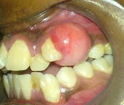 Image result for granuloma gum disease