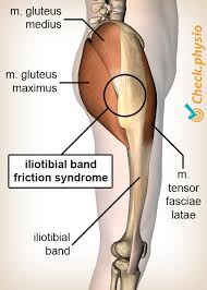 Learn the anatomy of this muscle now at kenhub! Greater Trochanter Pain Syndrome Physio Check