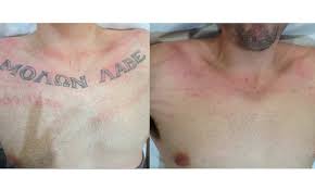 Or tattoo fading service calgary? Gallery Picoway Tattoo Pigment Removal