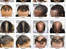 A faster metabolism digests food faster, burns calories faster, and grows hair faster. Can Cbd Oil Treat Thinning Hair And Hair Loss