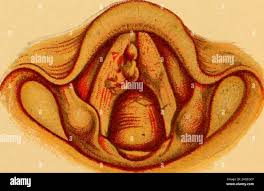 Image result for Acute Laryngitis