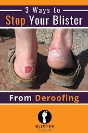 Deroofed Blisters Here S What You Need To Know Blister Prevention Healing Shoes Running Blisters Blisters