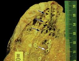 Image result for Humoral Immunodeficiency