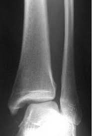 The lateral malleolus is the name given to the bone on the outside of the ankle joint. Ankle Fractures Trauma Orthobullets