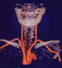 Gefass Lexikon A Carotis Gefasszentrum Bremen