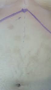 Some people claim that they have undergone plastic surgery to get such great bodies. Latif S Point A New Point For Veress Needle Insertion For Pneumoperitoneum In Difficult Laparoscopy Abd Ellatif 2018 Asian Journal Of Endoscopic Surgery Wiley Online Library