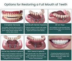 Image result for dental implant