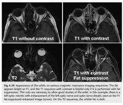 The timing of radiofrequency pulse sequences used to make t2 images results in images which highlight fat and water within the body. Neuro Ophthalmology Question Of The Week Magnetic Resonance Imaging Neuro Ophthalmology