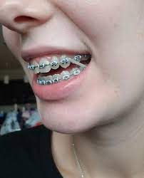 Braces Girlswithbraces Metalbraces Elastics Cute Braces Dental Braces Braces Teeth Colors