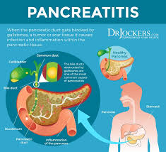 Pancreatitis Symptoms Causes And Natural Support Strategies In 2020 Pancreatitis Symptoms Acute Pancreatitis Gallstones Symptoms