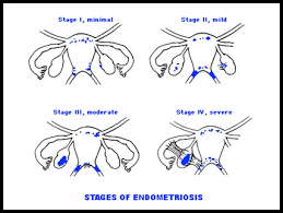 Endometriosis Stages F Ck Endo Endometriosis Stages