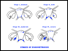 endometriosis stages f ck endo endometriosis stages