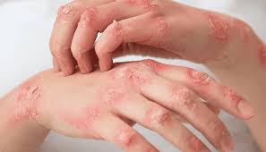 Image result for Atopic eczema atopic dermatitis