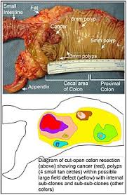 Ct scans can also be. Colorectal Cancer Wikipedia