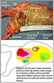 Even though there's a vaccine. Colorectal Cancer Wikipedia