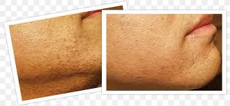 That laser emits pulses of light directly into the hair follicle, destroying the hair at its root so it can no longer grow back. Laser Hair Removal Skin Png 800x381px Hair Removal Chin Com Embarrassment Forehead Download Free